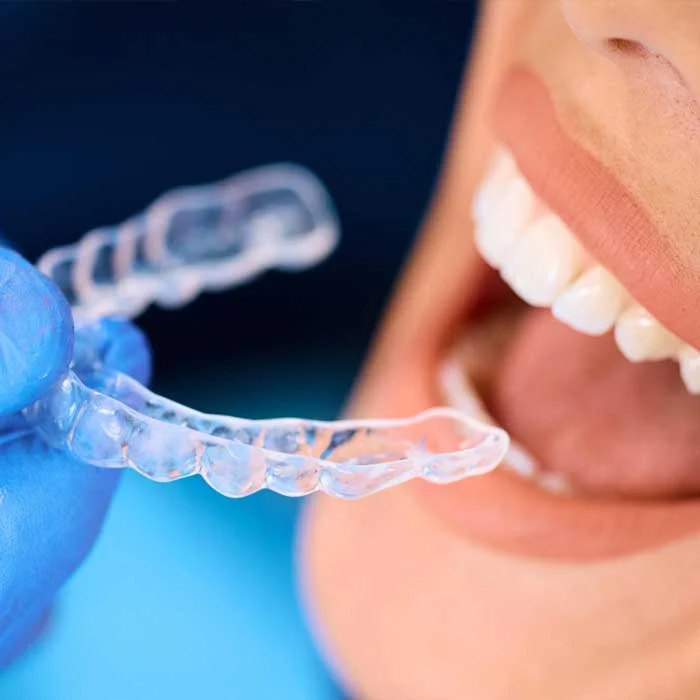 clear aligners dentalign plus